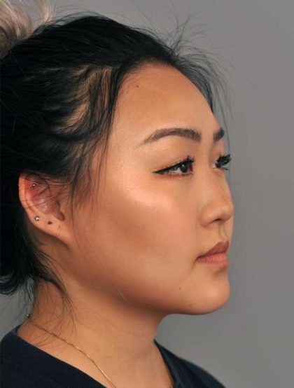 Buccal Fat Removal Before & After Patient #2118