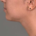 Buccal Fat Removal Before & After Patient #2127