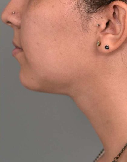Buccal Fat Removal Before & After Patient #2127