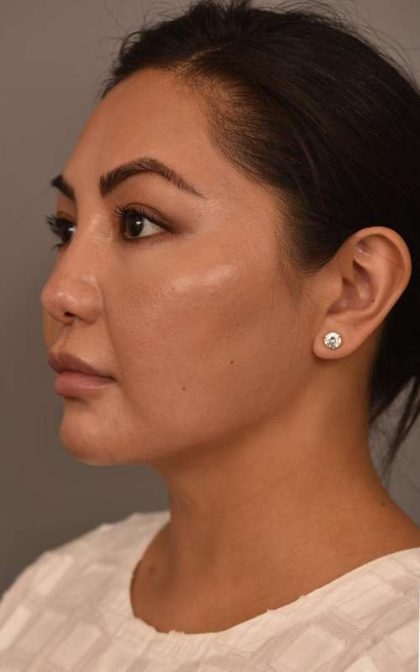 Cheek Liposuction Before & After Patient #2136