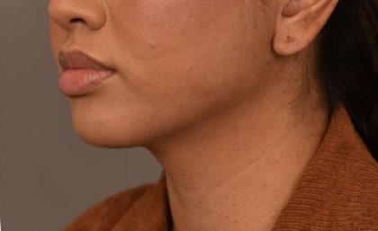 Cheek Liposuction Before & After Patient #2144