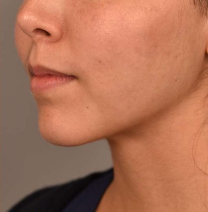 Cheek Liposuction Before & After Patient #2149
