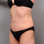 Tummy Tuck Before & After Patient #418