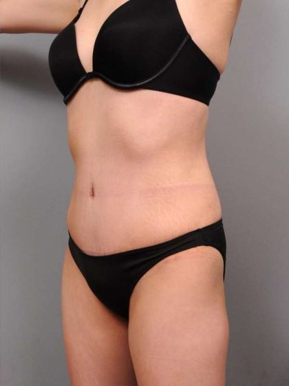 Tummy Tuck Before & After Patient #418
