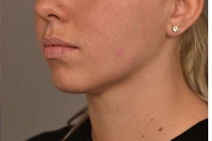 Cheek Liposuction Before & After Patient #2170