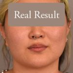 Cheek Liposuction Before & After Patient #2179