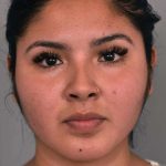 Cheek Liposuction Before & After Patient #2186