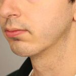 Chin Implant Before & After Patient #2203