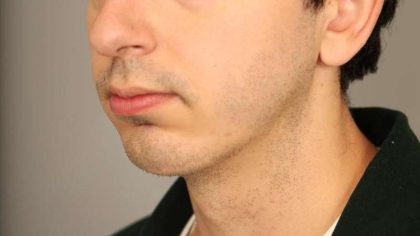 Chin Implant Before & After Patient #2203