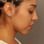 Chin Implant Before & After Patient #2210