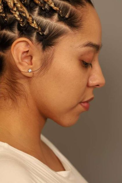 Chin Implant Before & After Patient #2210