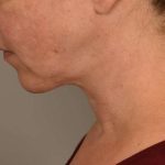 Chin Implant Before & After Patient #2220