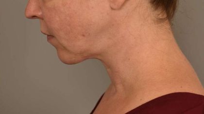 Chin Implant Before & After Patient #2220