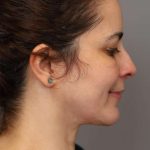 Chin Implant Before & After Patient #2227