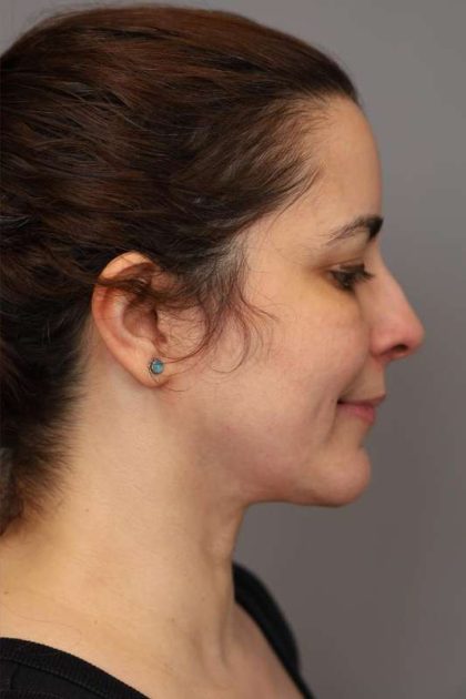Chin Implant Before & After Patient #2227