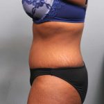 Tummy Tuck Before & After Patient #427
