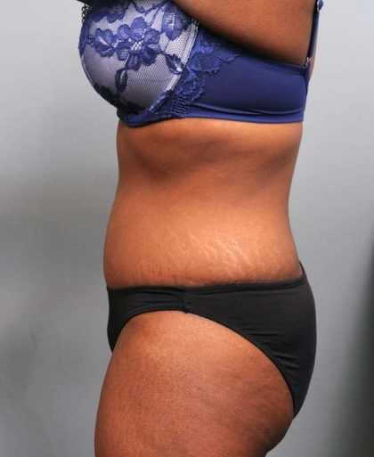 Tummy Tuck Before & After Patient #427