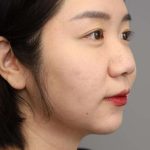 Chin Implant Before & After Patient #2234