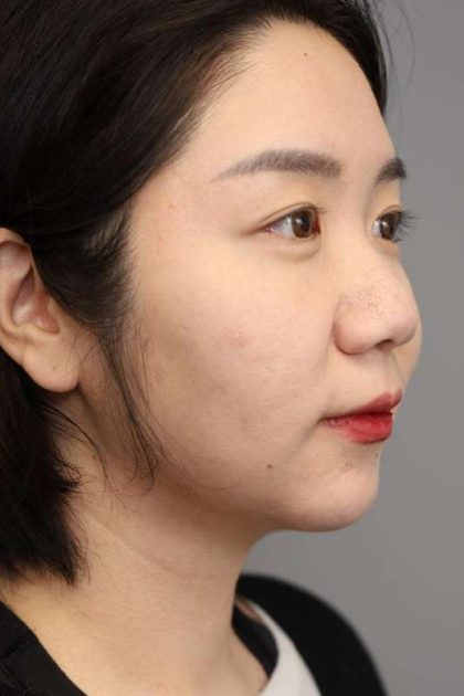 Chin Implant Before & After Patient #2234