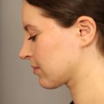 Chin Implant Before & After Patient #2243