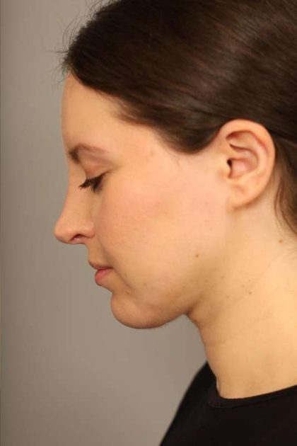 Chin Implant Before & After Patient #2243