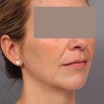 Chin Implant Before & After Patient #2253