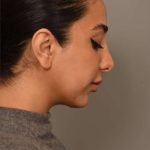 Chin Implant Before & After Patient #2269