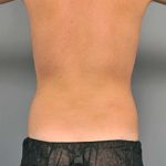 Liposuction For Men Before & After Patient #2294