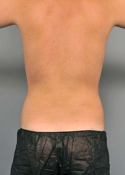 Liposuction For Men Before & After Patient #2294