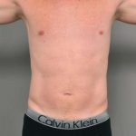 Liposuction For Men Before & After Patient #2301