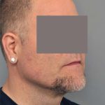 Liposuction For Men Before & After Patient #2308
