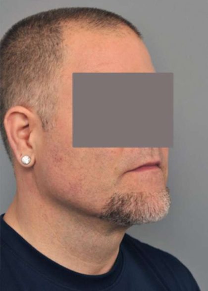 Liposuction For Men Before & After Patient #2308