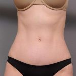 Tummy Tuck Before & After Patient #436