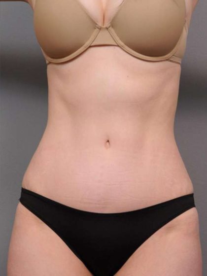 Tummy Tuck Before & After Patient #436