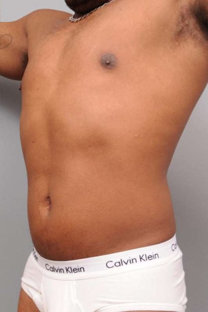 Liposuction For Men Before & After Patient #2330