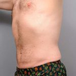 Liposuction For Men Before & After Patient #2337