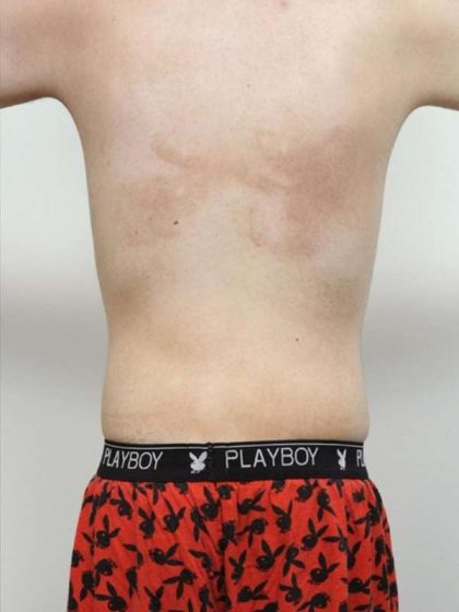 Liposuction For Men Before & After Patient #2342