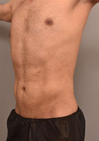 Liposuction For Men Before & After Patient #2358