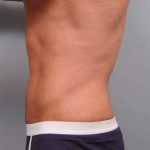 Liposuction For Men Before & After Patient #2386