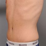 Tummy Tuck For Men Before & After Patient #2394