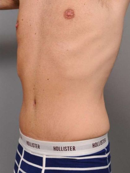 Tummy Tuck For Men Before & After Patient #2394