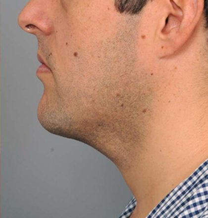 Neck Liposuction For Men Before & After Patient #2408