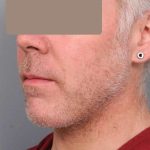 Neck Liposuction For Men Before & After Patient #2426
