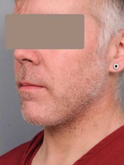 Neck Liposuction For Men Before & After Patient #2426