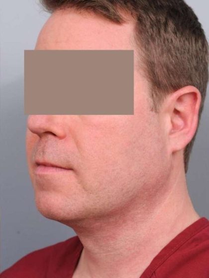 Neck Liposuction For Men Before & After Patient #2433