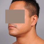 Neck Liposuction For Men Before & After Patient #2438