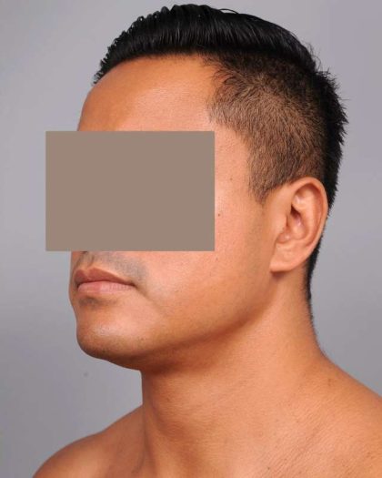 Neck Liposuction For Men Before & After Patient #2438