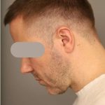 Neck Lift For Men Before & After Patient #2463