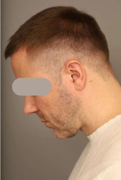 Neck Lift For Men Before & After Patient #2463