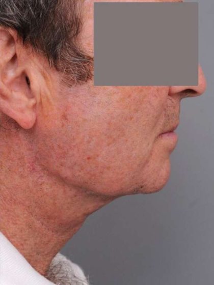 Neck Lift For Men Before & After Patient #2471